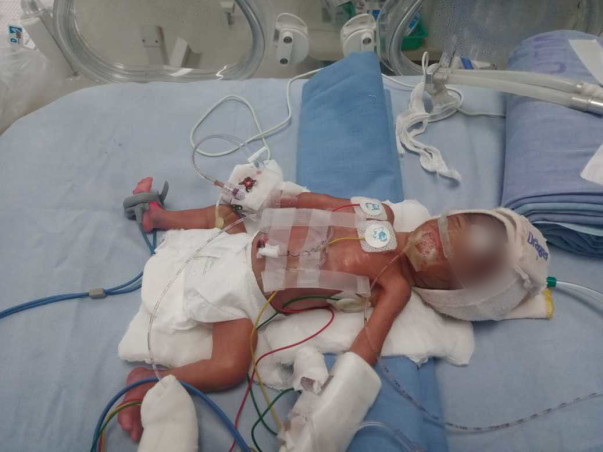 This 7 Days Old Needs Your Urgent Support In Preterm Twins