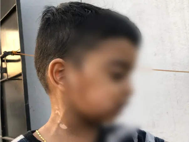 Help Nikhil Recover From Leucoderma