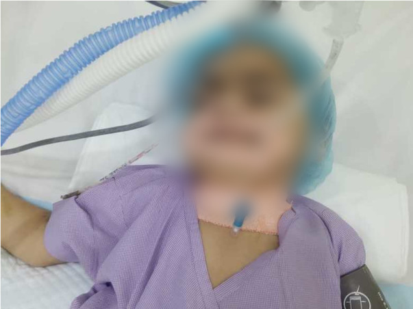 2 Years Old Siddhi Nagar Needs Your Help Fight Transverse Myelitis