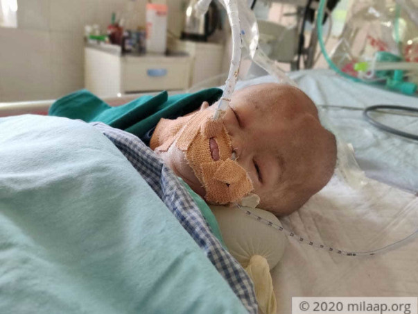 Born With A Head Twice The Size Of Normal, This Baby Is Critical