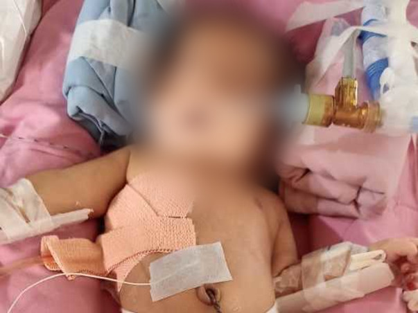 5 Days Old Baby Of Sai Krupa Needs Your Help Fight Polyhydramnios