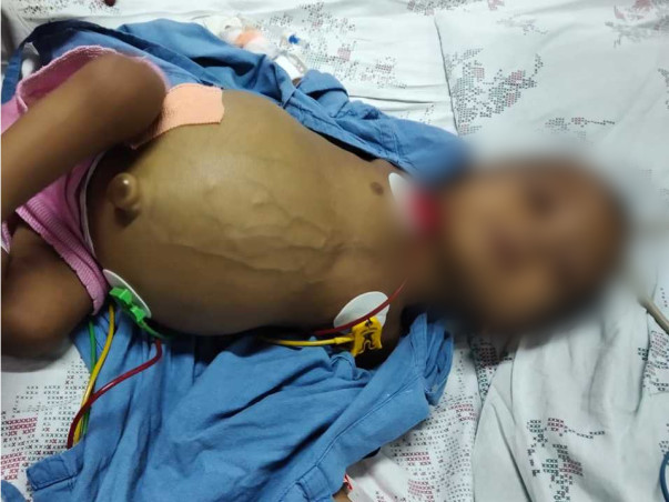 8 Months Old Yuvansh S/o Shiva Needs Help Fight Cholestatic Jaundice