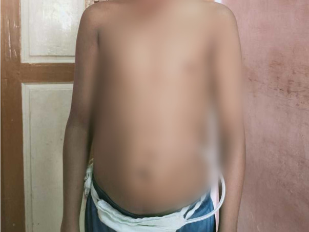 My 12 Year Old Nephew Is Struggling With Kidney Failure, Help Him