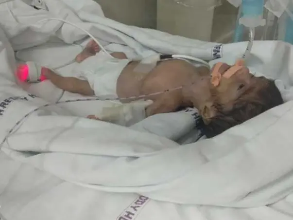 This 26 Weeks Preterm Child Needs Your Support To Survive