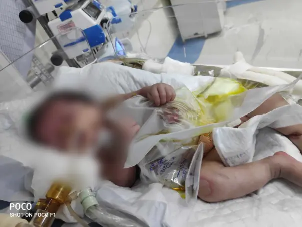 "Baby of Heena" Is Born Preterm With Respiratory Distress Syndrome,Help Her