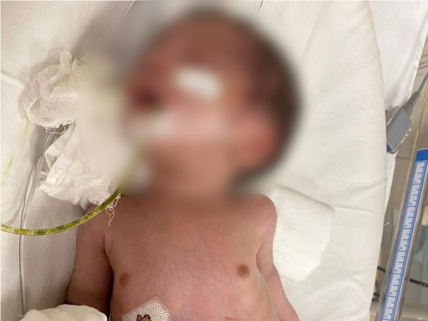 Support Baby of Nitesh fight/recover from ileal atresia