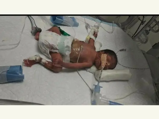 My One And Half Months Daughter Is Struggling With Preterm Issues, Please Help Her