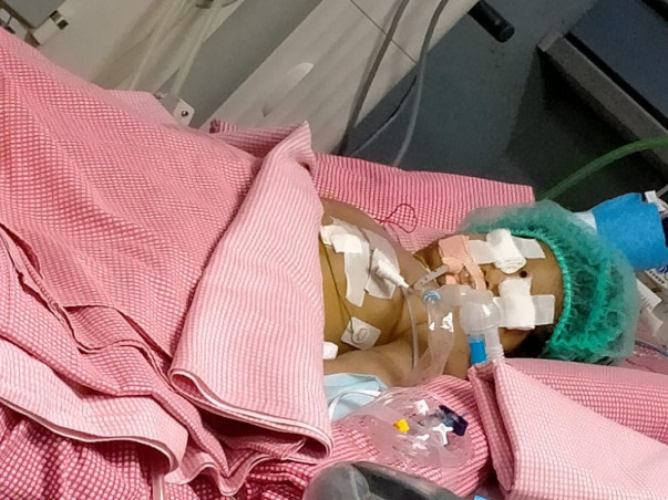 9 months old ANJANEYA DEVANSH fight Chronic lung disease, Sepsis-septic shock, Acute Kidney Injury, Acute Liver Injury, DIC, Cardiac arrhythmia