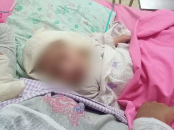 6 months Baby with "Water on the Brain"