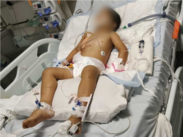 This 4 years old needs your urgent support in fighting Multiple calvarial and facial bone fractures