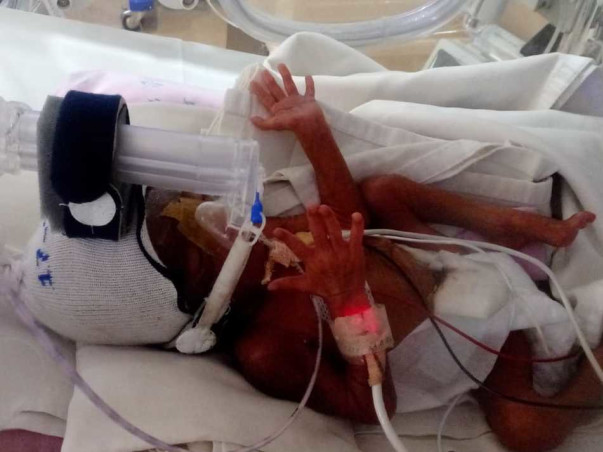 Help My Sister's Baby Recover Preterm With Low Birth Weight