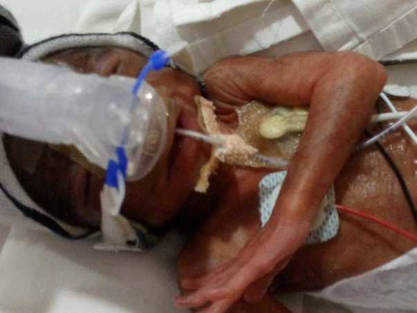 Help My Sister's Baby Recover Preterm With Low Birth Weight