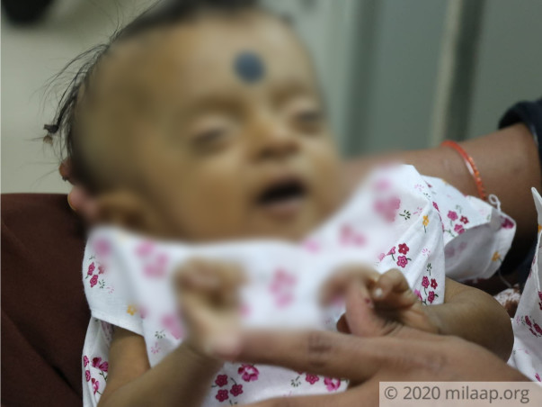 This Baby Is Shrinking Instead Of Growing Due To Rare Disease