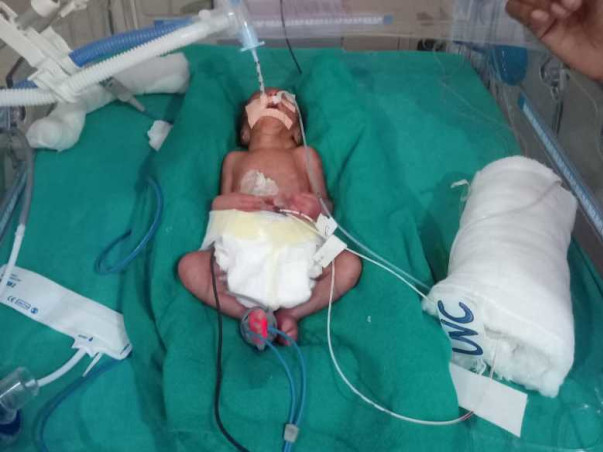 Help Critical Pre Term Twin Babies in NICU