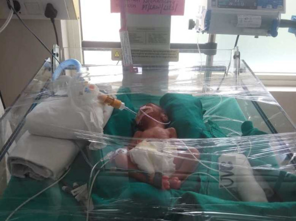Help Critical Pre Term Twin Babies in NICU