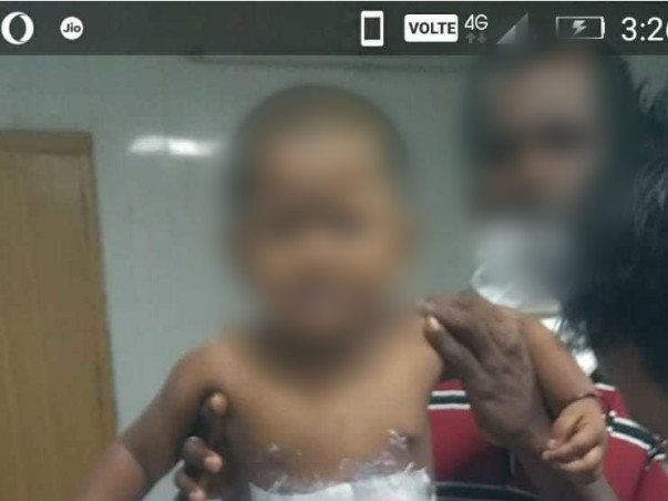 Please Help My Nephew from Severe Burn