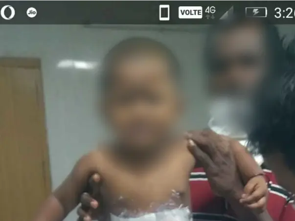 Please Help My Nephew from Severe Burn