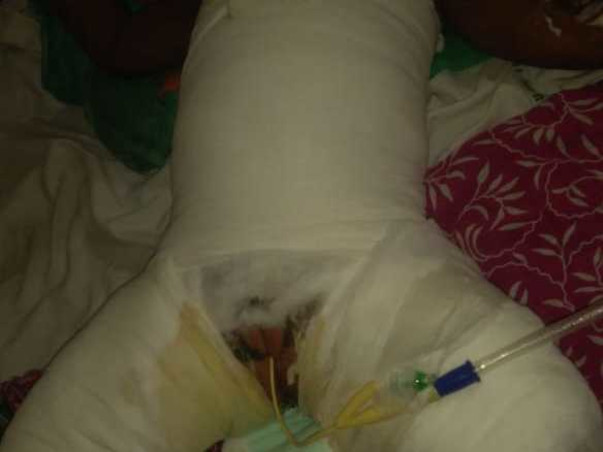 Please Help My Nephew from Severe Burn