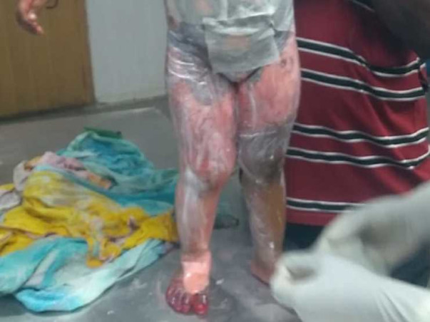 Please Help My Nephew from Severe Burn