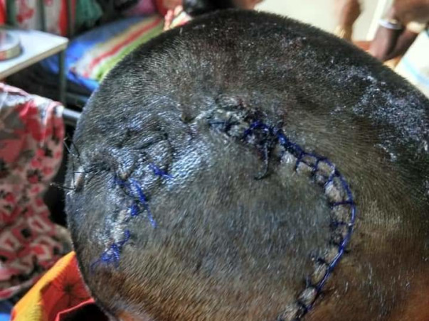 Help Aparna for life saving treatment of her brain tumor