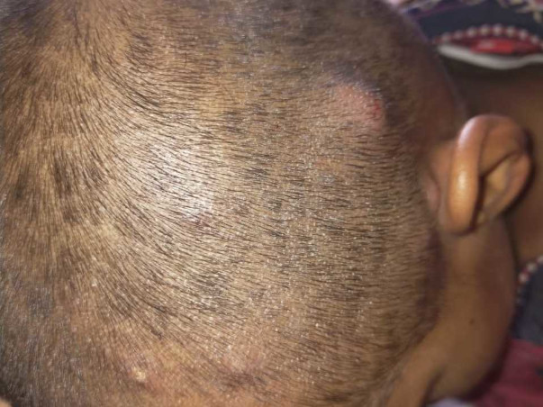 Support Alok Kumar Gowda Recover From Primary Immunodeficiency