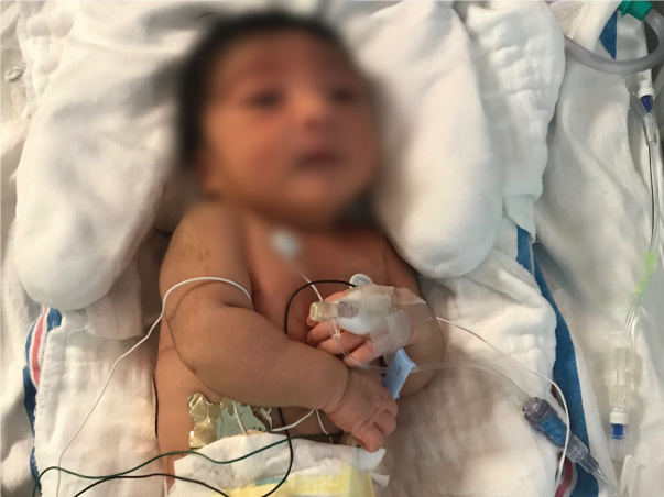 Cure Raghav - Rare disorder in GPX4 gene