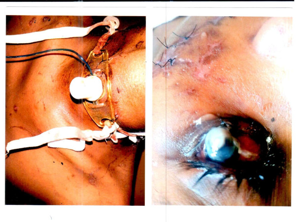 Please Help 11 Years Old Anjan Kumar Suffering From Bear Attack