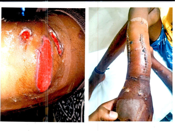 Please Help 11 Years Old Anjan Kumar Suffering From Bear Attack