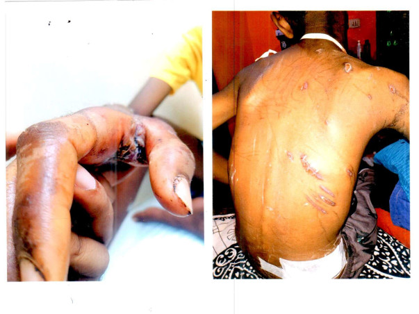 Please Help 11 Years Old Anjan Kumar Suffering From Bear Attack