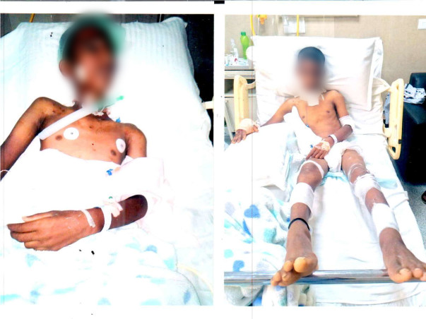 Please Help 11 Years Old Anjan Kumar Suffering From Bear Attack