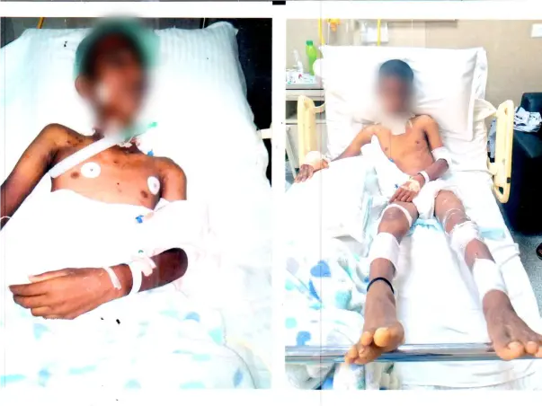 Please Help 11 Years Old Anjan Kumar Suffering From Bear Attack