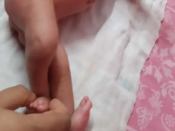 1 month old Aahan Needs Your Help Fight Arthrogryposis Multiplex Congenita