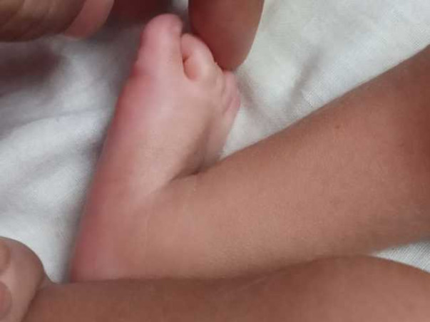 1 month old Aahan Needs Your Help Fight Arthrogryposis Multiplex Congenita