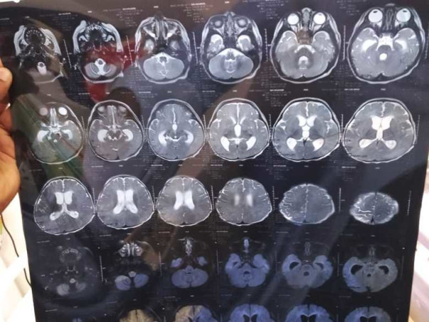 Help Baby Undergo Post Brain Tb Treatment