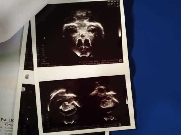 Help Baby Undergo Post Brain Tb Treatment