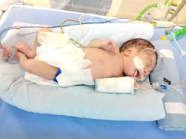 12 Days Old Baby Of Kayalvizhi Needs Your Help Fight Prematurity With Respiratory Distress Syndrome