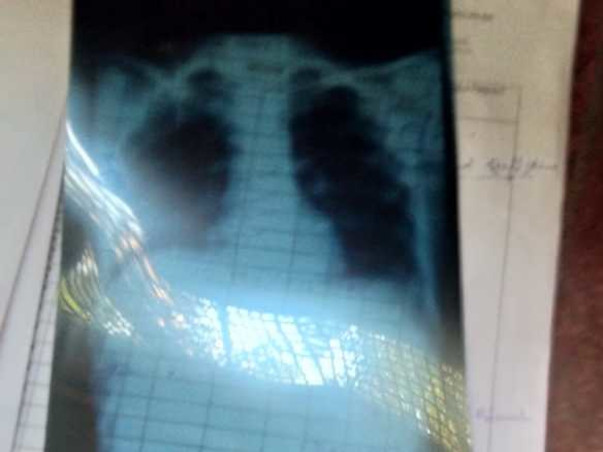 This 16 Years Old Needs Your Urgent Support in Fighting Liver Abscess