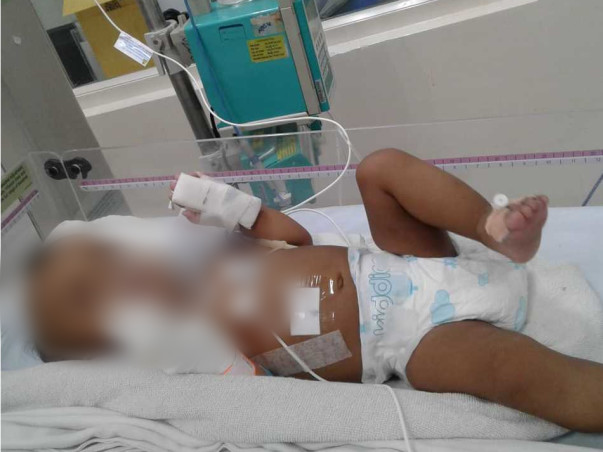 Support Gracy Recover From Hydrocephalus