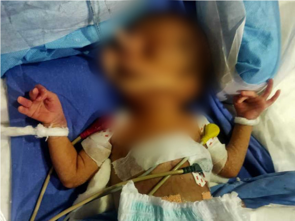 14 Days Old Baby Shivam Needs Your Help Fight Preterm Birth