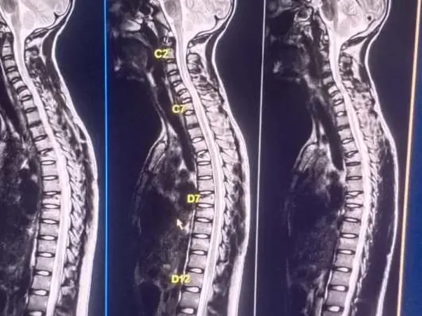 Help my friend Dogga ramasatyam fight Backbone cracks