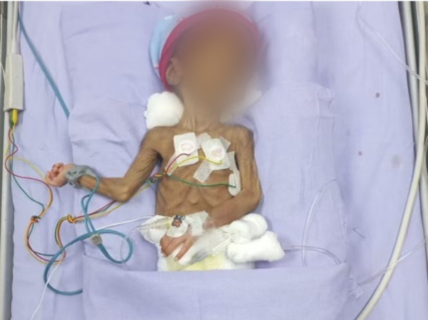 Help Sravanthi Twin 1(still unnamed) fight ileostomy closure surgery
