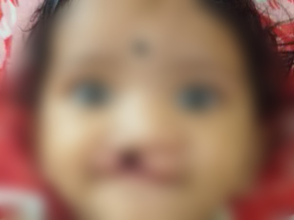My Daughter Is Struggling With Cleft Lip, Help Her
