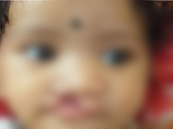My Daughter Is Struggling With Cleft Lip, Help Her