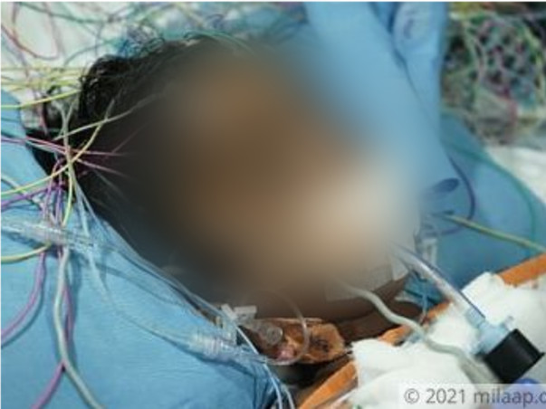 Support Likitha Recover From Brain Infection