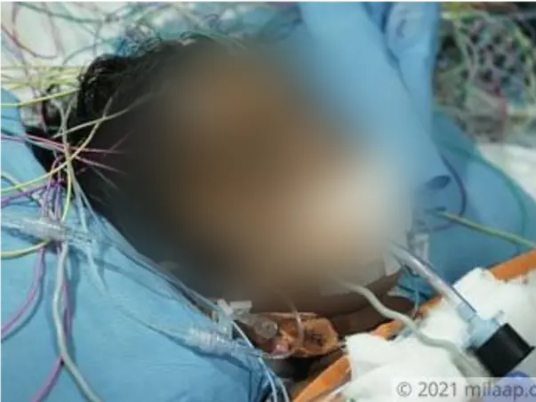 Support Likitha Recover From Brain Infection
