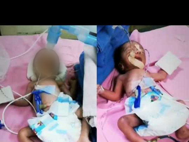 Support  Preterm Born Twins Babies For Their NICU Treatment