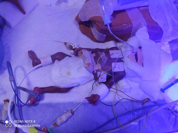 SUPPORT NANDINI TO SAVE HER PREMATURE BABY