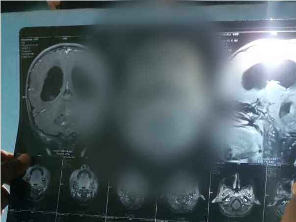 Support Pavishna Recover From Brain Tumor