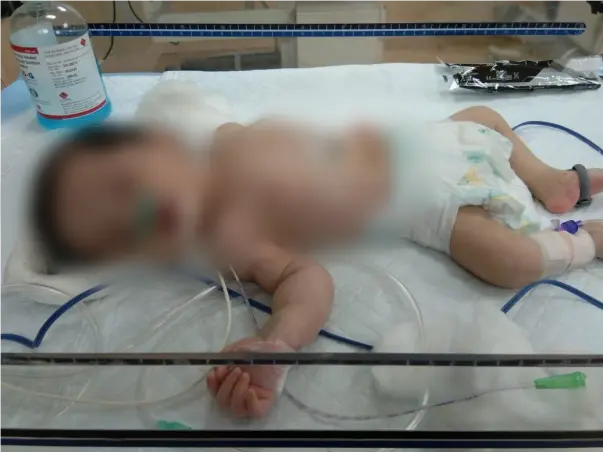 Support Baby Of Akhila To Recover From Msud Maple Syrup Urine Disease