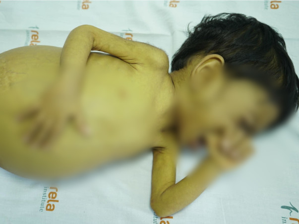 Support Angel Chirag Parmar Recover From Liver Failure